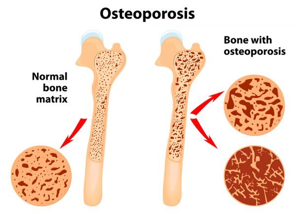 Normal bone vs Bone with Osteoporosis