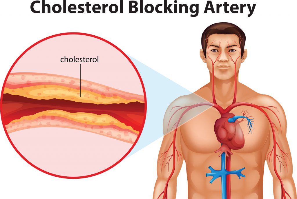 Heart Disease: Cholesterol