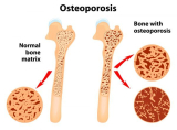 Osteoporosis: Causes, Symptoms, Overview, and More
